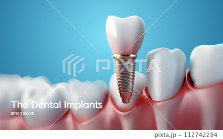 White tooth implant implant cut, healthy tooth or dental surgery. 112742284