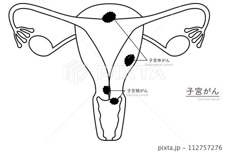 子宮がんの図解イラスト、子宮・卵巣の解剖図 子宮がんの図解イラスト、子宮・卵巣の解剖図 112757276