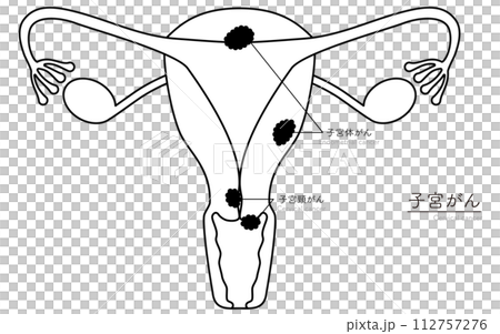 子宮がんの図解イラスト、子宮・卵巣の解剖図 子宮がんの図解イラスト、子宮・卵巣の解剖図 112757276