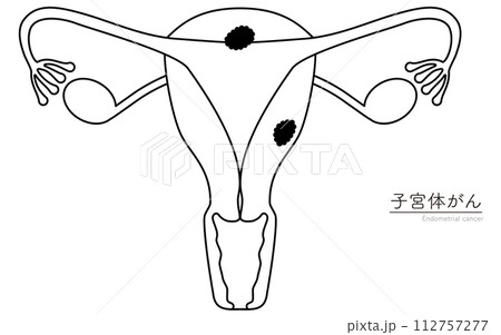 子宮体がんの図解イラスト、子宮・卵巣の解剖図 112757277