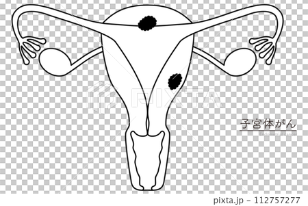 子宮体がんの図解イラスト、子宮・卵巣の解剖図 112757277