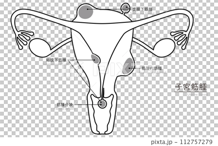 子宮筋腫の図解イラスト、子宮・卵巣の解剖図のイラスト素材 [112757279] - PIXTA