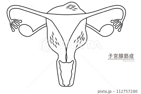 子宮腺筋症の図解イラスト、子宮・卵巣の解剖図 112757280
