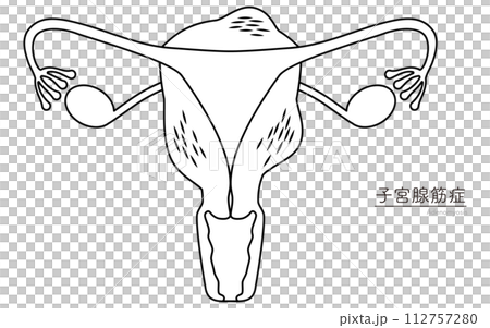 子宮腺筋症の図解イラスト、子宮・卵巣の解剖図 112757280