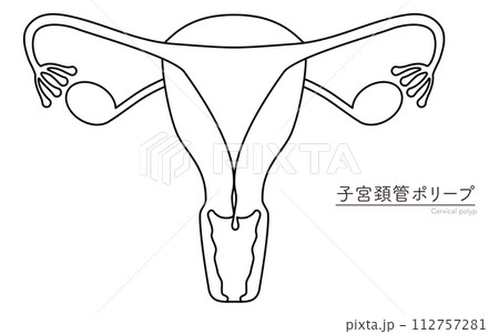子宮頚管ポリープの図解イラスト、子宮・卵巣の解剖図 112757281