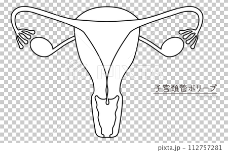 子宮頚管ポリープの図解イラスト、子宮・卵巣の解剖図 112757281