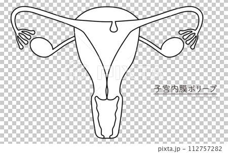 子宮内膜ポリープの図解イラスト、子宮・卵巣の解剖図 112757282