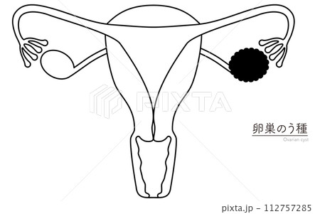 卵巣のう種の図解イラスト、子宮・卵巣の解剖図 112757285