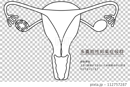 Illustrated illustration of polycystic ovary syndrome (ovulation disorder), anatomical diagram of the uterus and ovaries Illustrated illustration of polycystic ovary syndrome (ovulation disorder), anatomical diagram of the uterus and ovaries 112757287