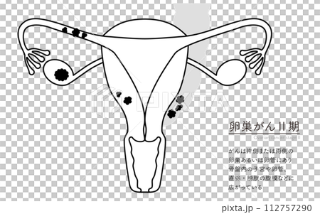卵巣がんII期の図解イラスト、子宮・卵巣の解剖図 112757290
