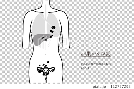 卵巢癌 IV 期圖解,子宮和卵巢的解剖圖 卵巢癌 IV 期圖解,子宮和卵巢的解剖圖 112757292
