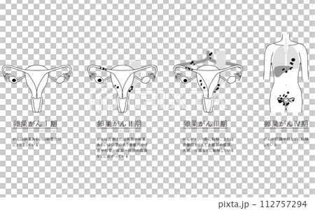 Illustrated illustration of ovarian cancer stage I, anatomical diagram of the uterus and ovaries 112757294