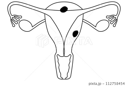 子宮体がんの図解イラスト、子宮・卵巣の解剖図 112758454