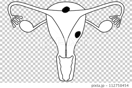 子宮体がんの図解イラスト、子宮・卵巣の解剖図 112758454