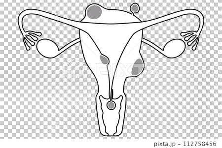 子宮筋腫の図解イラスト、子宮・卵巣の解剖図のイラスト素材 [112758456] - PIXTA
