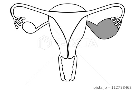 子宮内膜症の図解イラスト、子宮・卵巣の解剖図 112758462