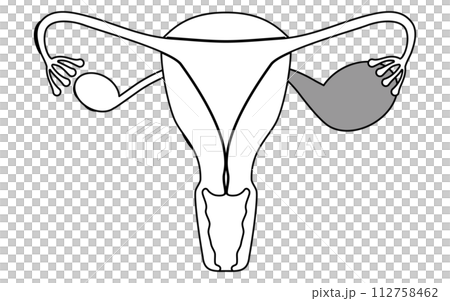 子宮内膜症の図解イラスト、子宮・卵巣の解剖図 112758462