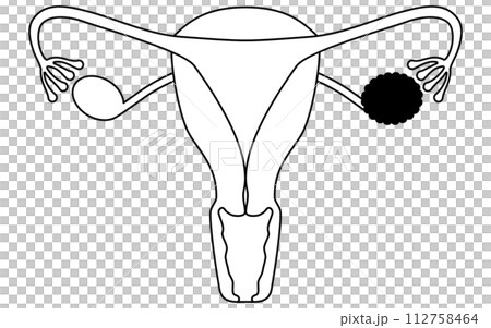 卵巣のう種の図解イラスト、子宮・卵巣の解剖図 112758464