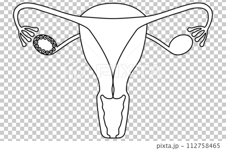 多囊性卵巢症候群(成熟障礙)插圖、子宮和卵巢解剖圖 多囊性卵巢症候群(成熟障礙)插圖、子宮和卵巢解剖圖 112758465