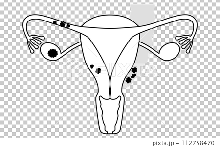 Illustrated illustration of ovarian cancer stage II, anatomical diagram of the uterus and ovaries 112758470
