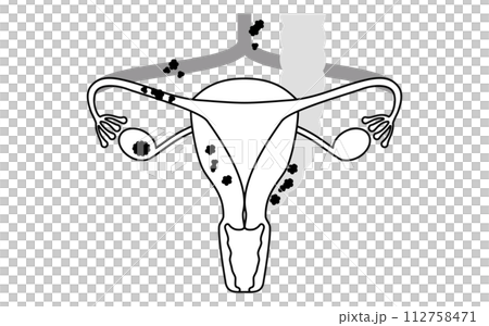 Illustrated illustration of ovarian cancer stage III, anatomical diagram of the uterus and ovaries 112758471