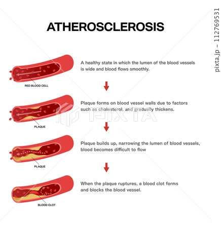 血管の流れと動脈硬化の説明図 医療イラスト 血管の流れと動脈硬化の説明図 医療イラスト 112769531