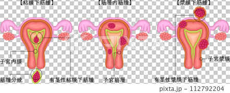 Uterine fibroid classification illustration 112792204