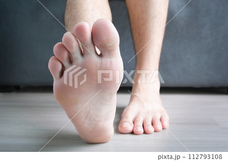 Cracked, dry and peeling skin on the toes from a fungal infection. of dirty shoes Cracked, dry and peeling skin on the toes from a fungal infection. of dirty shoes 112793108