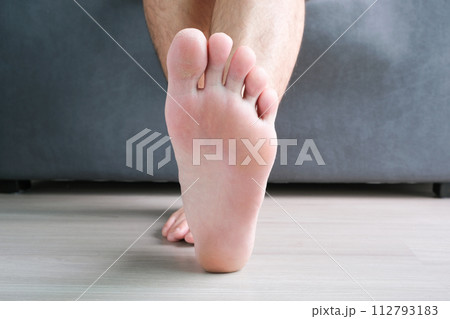 Cracked, dry and peeling skin on the toes from a fungal infection. of dirty shoes Cracked, dry and peeling skin on the toes from a fungal infection. of dirty shoes 112793183