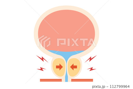 前立腺肥大症の医療イラスト、肥大した前立腺 112799964