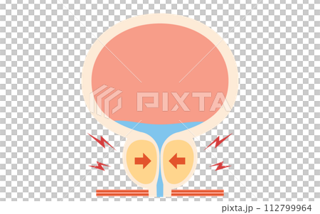 前立腺肥大症の医療イラスト、肥大した前立腺 112799964