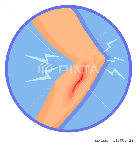 Human leg with bleeding wound. Medical injury illustration 112803422