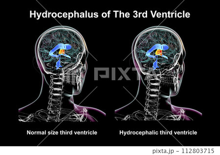 Enlargement of the third brain ventricle, 3D illustration 112803715