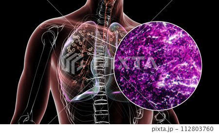 Lungs affected by silicosis, 3D illustration and micrograph 112803760