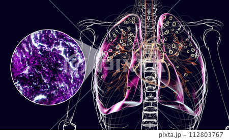 Lungs affected by silicosis, 3D illustration and micrograph 112803767