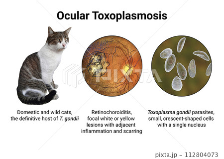 Ocular toxoplasmosis, retinal scar caused by a Toxoplasma gondii infection, scientific illustration 112804073