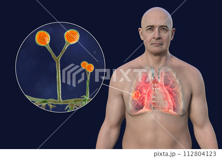 A man with lung mucormycosis lesion, with close-up view of Rhizomucor fungi, 3D illustration 112804123