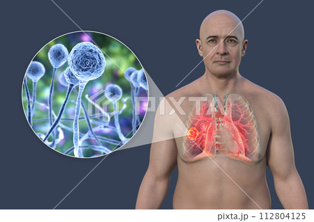 A man with lung mucormycosis lesion, with close-up view of Mucor fungi, 3D illustration 112804125