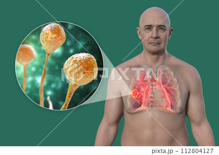 A man with lung mucormycosis lesion, with close-up view of Mucor fungi, 3D illustration 112804127