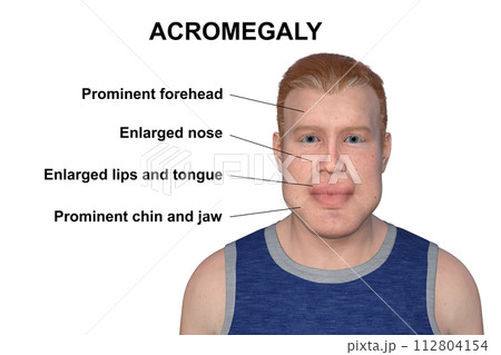 Acromegaly in a man, and the same healthy person, 3D illustration Acromegaly in a man, and the same healthy person, 3D illustration 112804154
