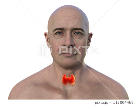 A man with a normal thyroid gland, 3D illustration A man with a normal thyroid gland, 3D illustration 112804469