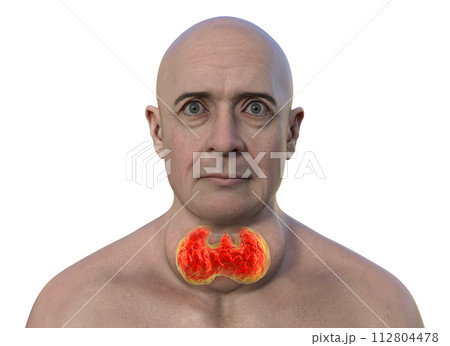 A man with enlarged thyroid gland, 3D illustration A man with enlarged thyroid gland, 3D illustration 112804478