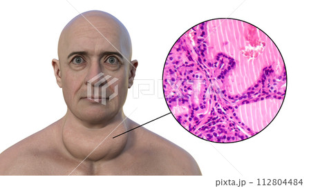 A man with enlarged thyroid gland, 3D illustration, and micrograph toxic goiter A man with enlarged thyroid gland, 3D illustration, and micrograph toxic goiter 112804484