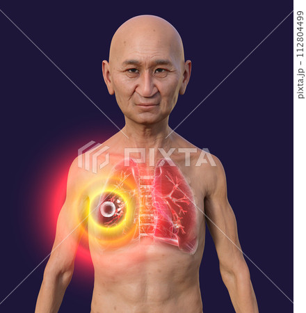A man with the lungs affected by cavernous tuberculosis, 3D illustration A man with the lungs affected by cavernous tuberculosis, 3D illustration 112804499