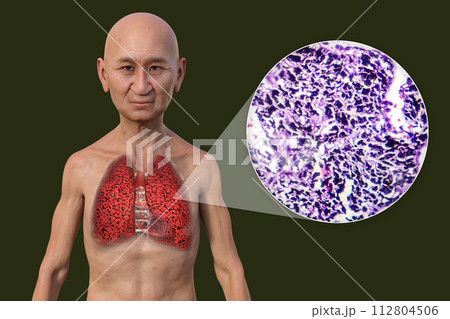 A man with smoker's lungs, 3D illustration and micrograph 112804506