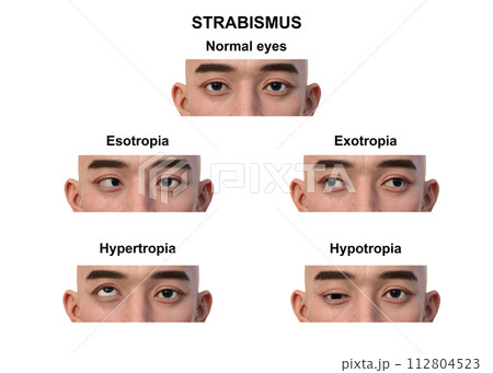 A man with various strabismus types, 3D illustration 112804523