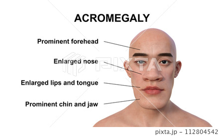 Acromegaly in a man, 3D illustration 112804542