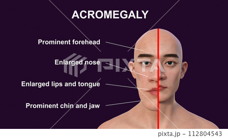Acromegaly in a man, 3D illustration 112804543
