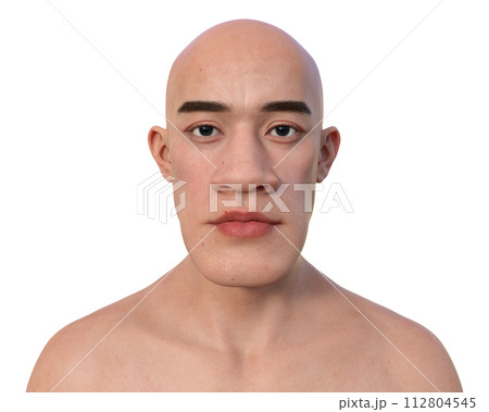 Acromegaly in a man, 3D illustration 112804545