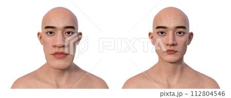 Acromegaly in a man, and the same healthy man, 3D illustration 112804546